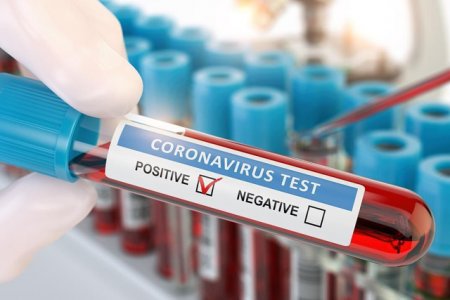 Moldovada daha 304 nəfər koronavirusa yoluxdu