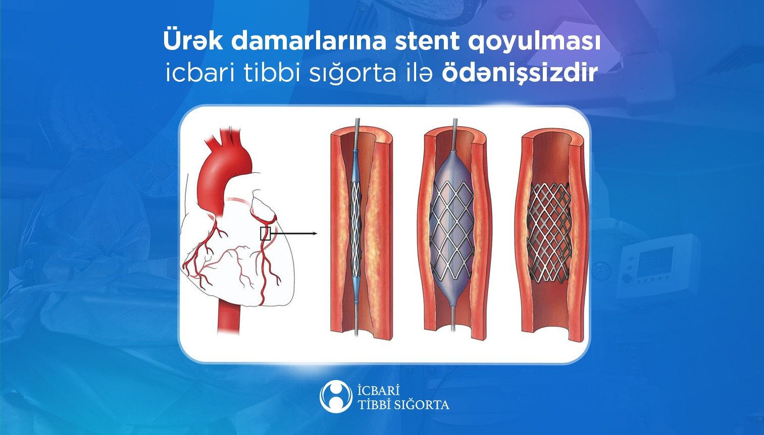 Ürək damarlarına stent qoyulması icbari tibbi sığorta ilə ödənişsizdir
