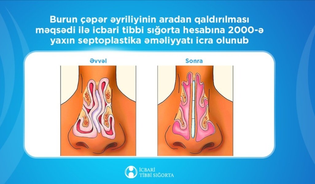 İcbari tibbi sığorta ilə 2000-ə yaxın burun çəpəri əməliyyatı icra olunub