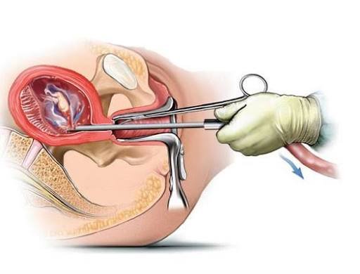 95 min 117 abort: Azərbaycanın səssiz demoqrafik fəlakəti