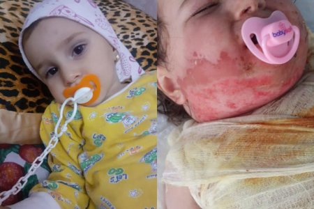 Отчаявшаяся мать двухлетней девочки, получившей тяжелые ожоги: У нас нет денег даже на еду - ФОТО