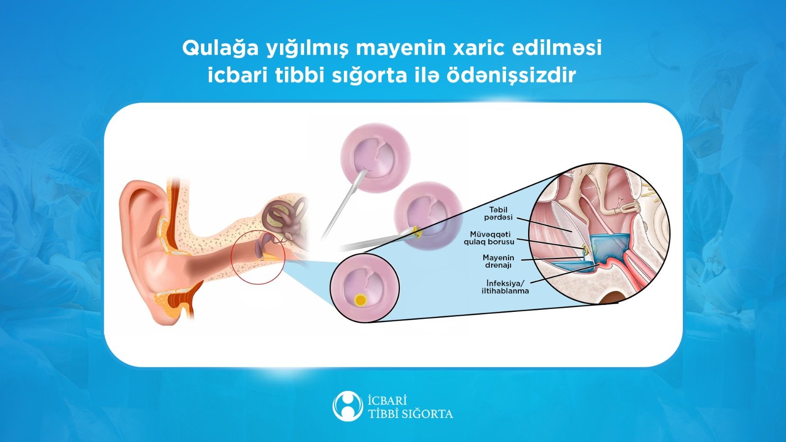 Kəskin orta otitin cərrahi müalicəsi icbari tibbi sığorta ilə qarşılanır