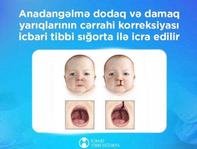 Anadangəlmə dodaq və damaq yarıqlarının cərrahi korreksiyası icbari tibbi sığorta ilə icra edilir