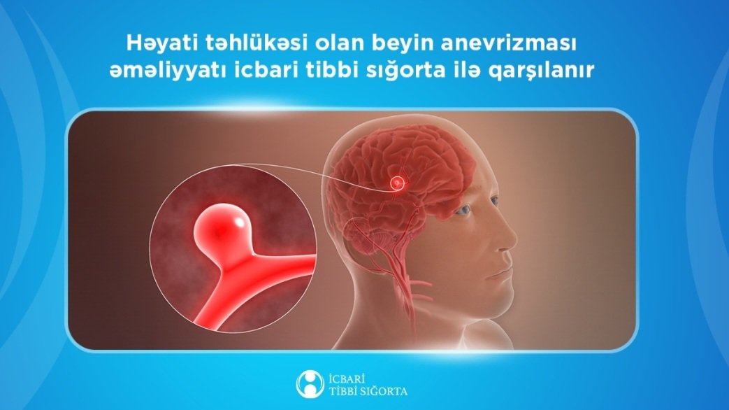 Həyati təhlükəsi olan beyin anevrizması əməliyyatı icbari tibbi sığorta ilə qarşılanır