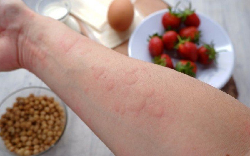 Allerqoloq qida allergiyası ilə bağlı valideynlərə çağırış edib: həkimə müraciət edin