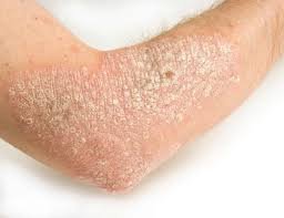 Psoriaz - Ondan qurtuluş yoxdur - Fotolar